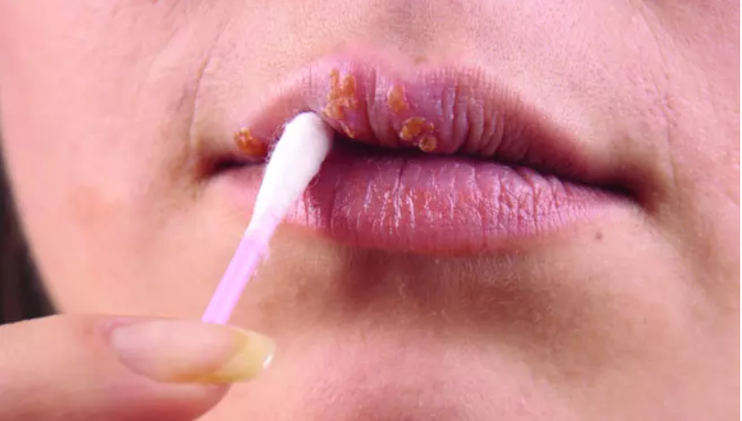 HPV y la boca