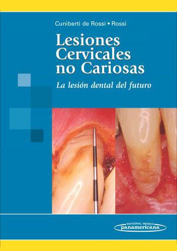 lesiones-cervicales-no-cariosas